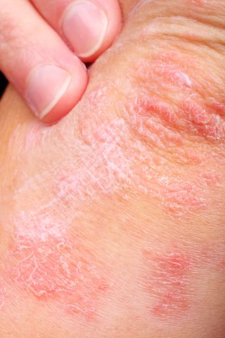 Psoriasis Nov 4,09