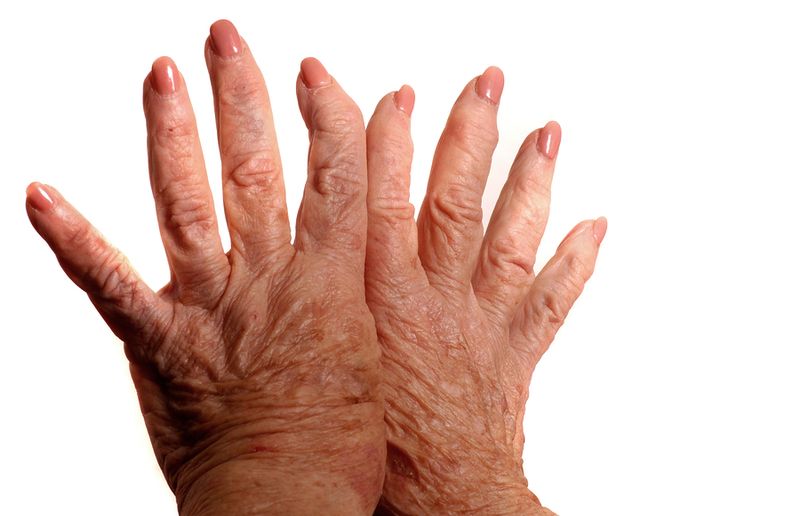 Bigstockphoto_Arthritic_Hands_494106